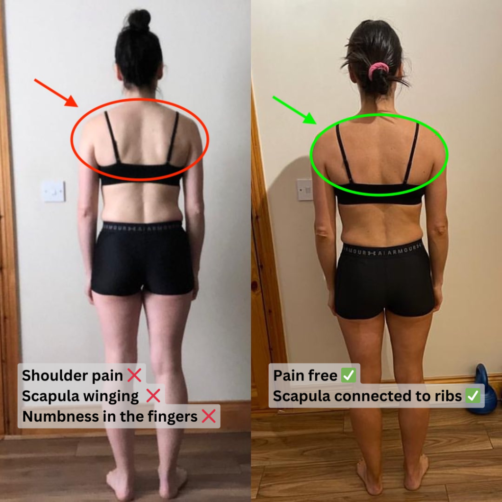 Side profile posture alignment before and after at Bristol Biomechanics.